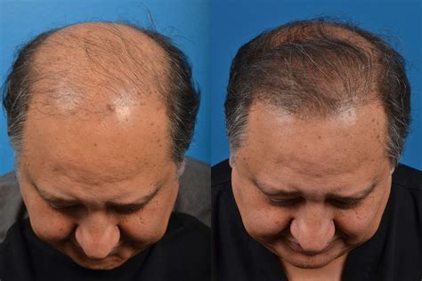 Hair Restoration photo