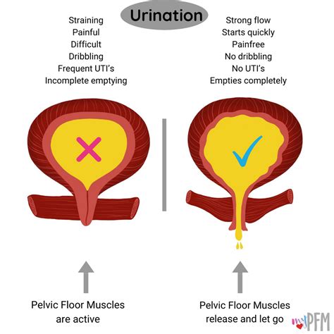 Incontinence & Overactive Bladder photo