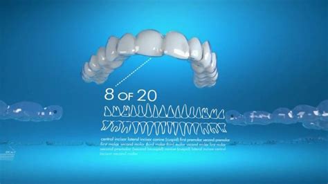 Invisalign TV commercial - Gradually Straighten Your Teeth