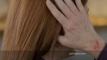 Psoriasis Speaks TV Spot, 'Rings'