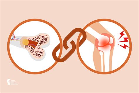 Osteoporosis & Arthritis photo