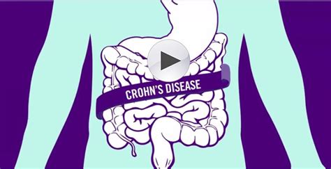 Stelara (Crohn's Disease) logo